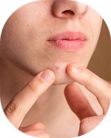 acne-tratamento-3