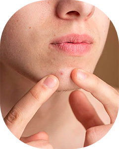 acne-tratamento-3